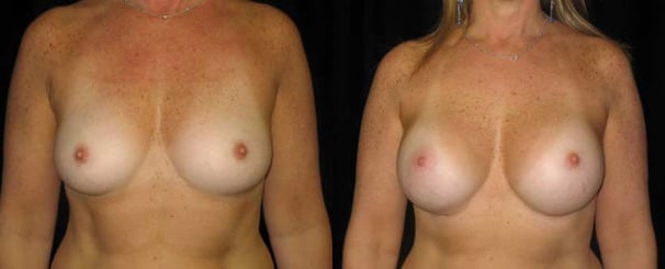 breast-augmentation-before-after