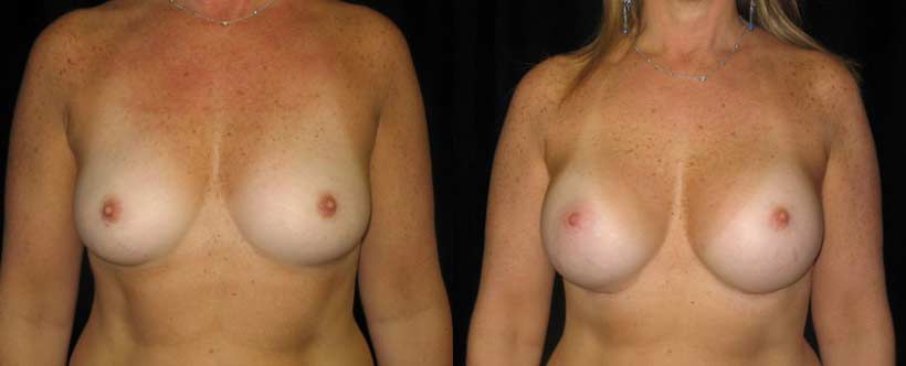 breast-augmentation-before-after