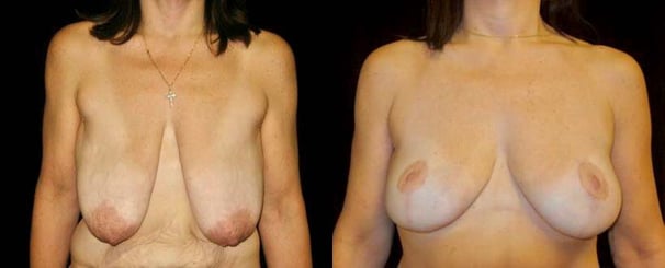 breast-lift-before-after