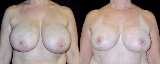 brest-reduction-before-after