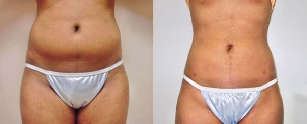 lipo-before-after
