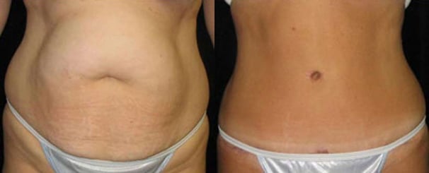 tummy-tuck-before-after