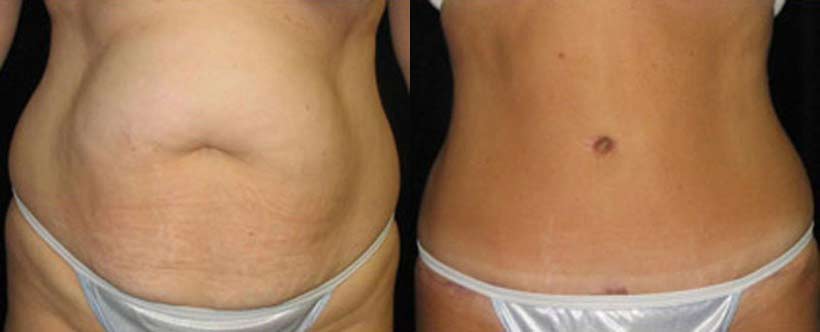 tummy-tuck-before-after