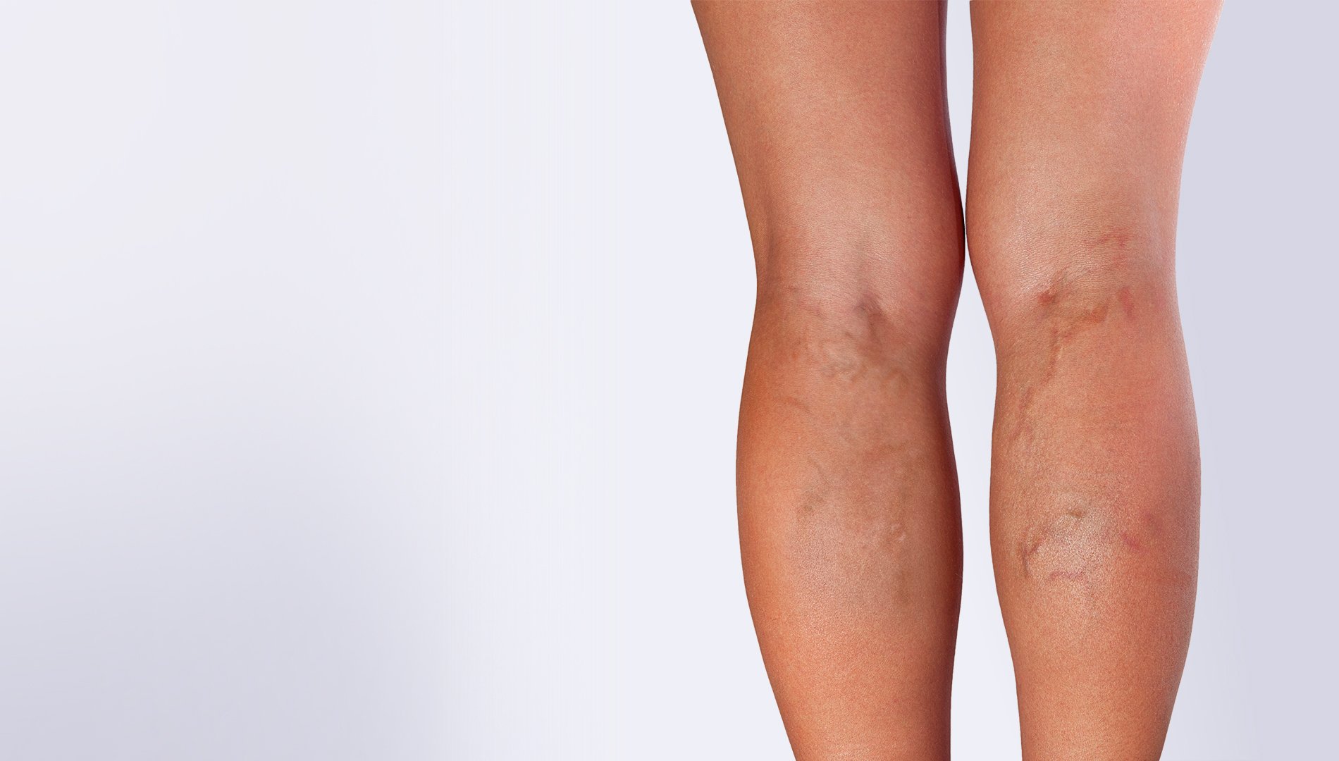Get Rid of Varicose Veins with Injection Sclerotherapy