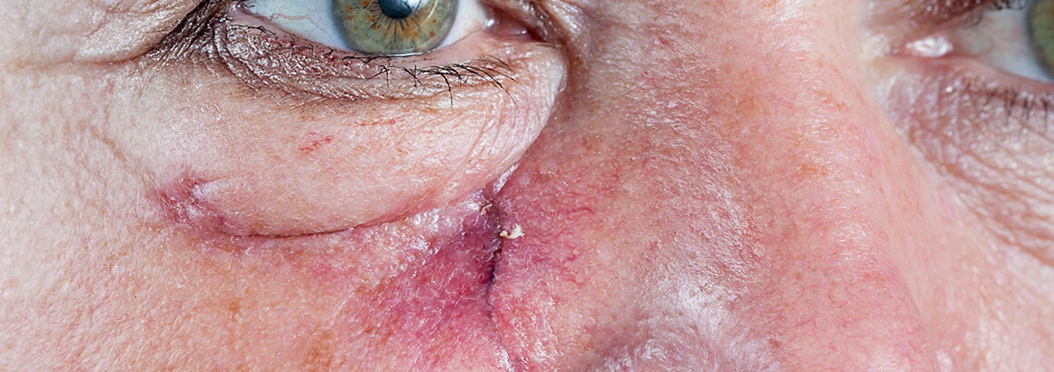 Mohs surgery for Basal Cell Carcinoma