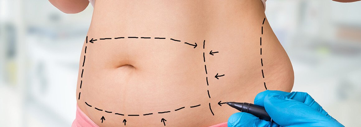 Plastic surgery doctor draw lines with marker on patient belly