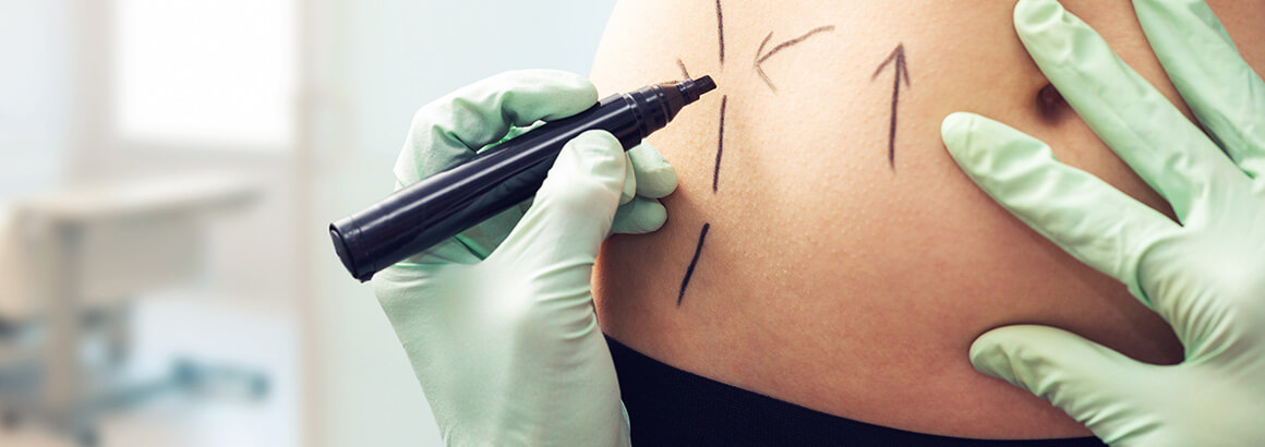 Plastic surgery doctor draw lines with marker on patient stomach