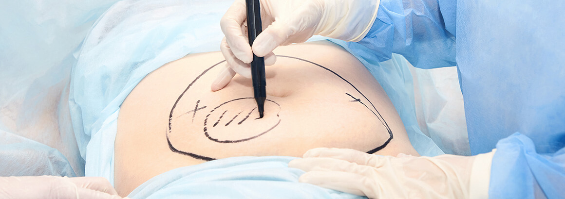 doctor preparing for liposuction