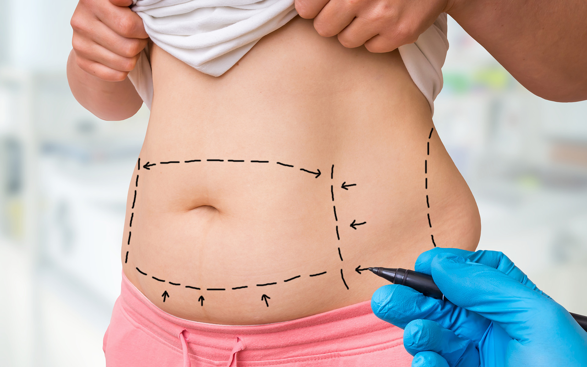 preparing for liposuction