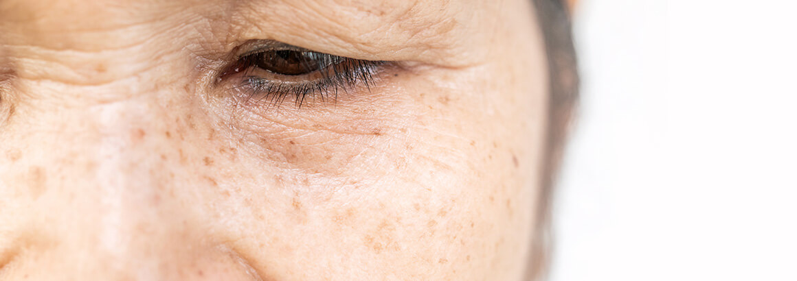 senior asian woman drooping eyelid