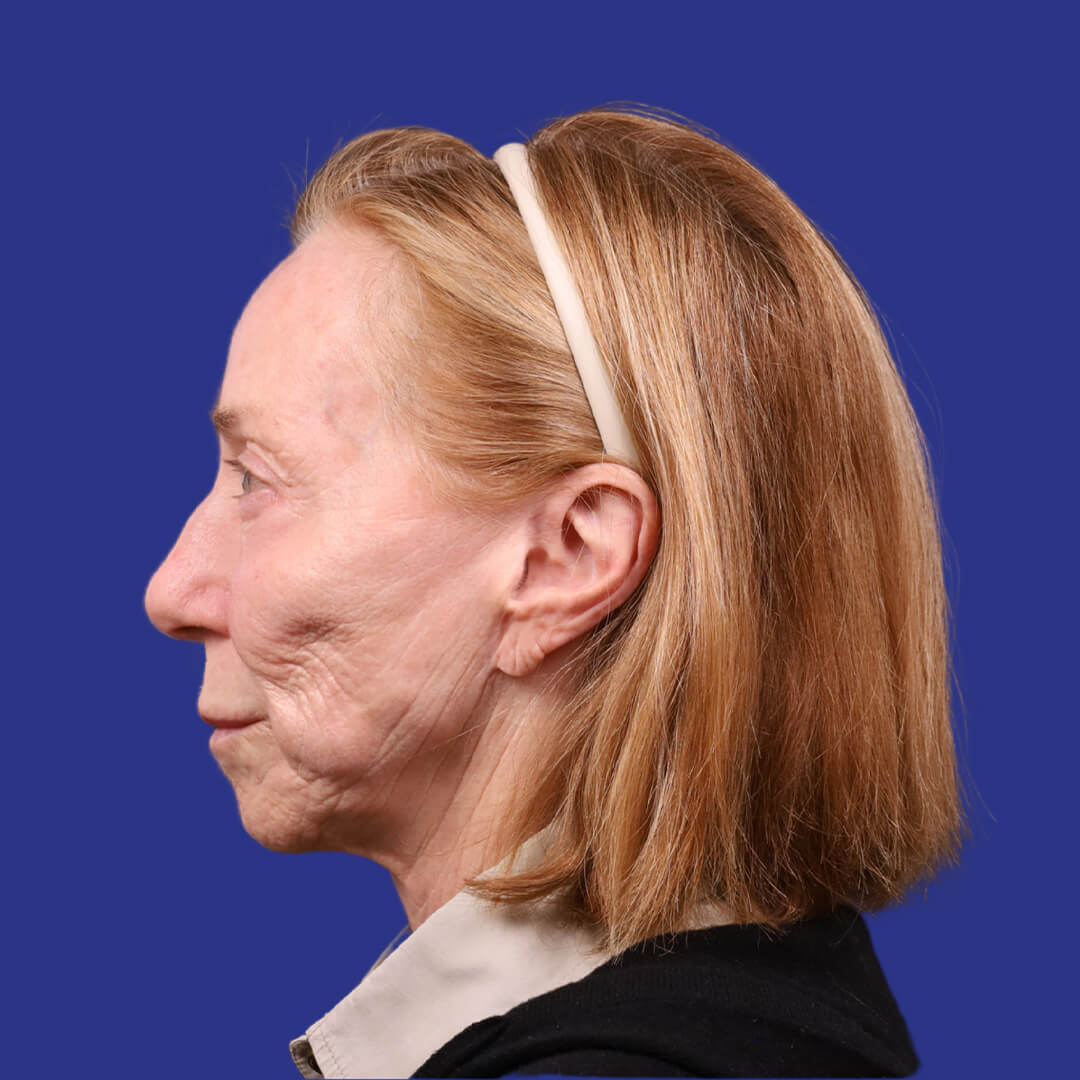 Before image