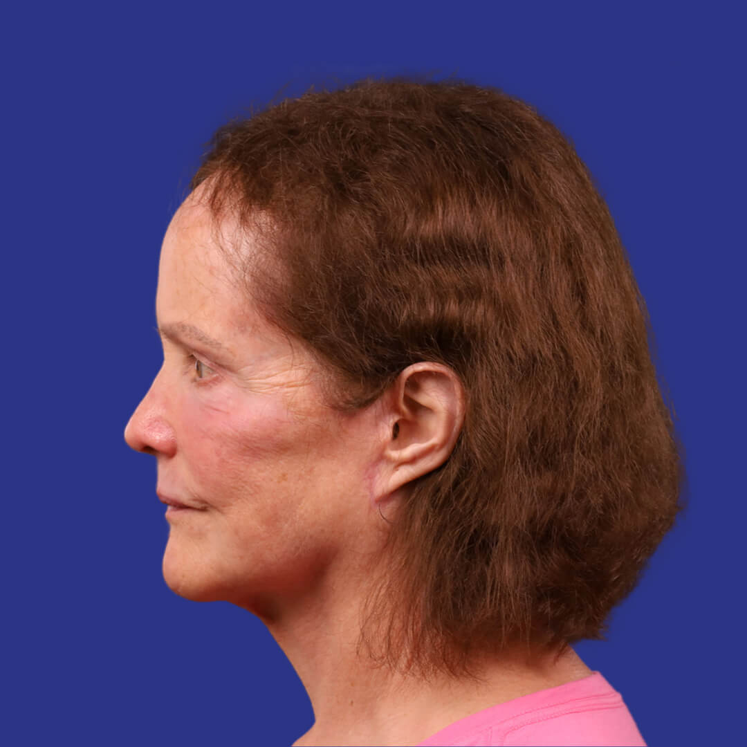 After image