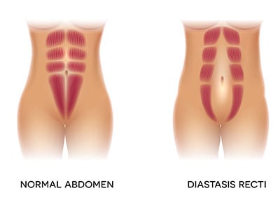 Diastasis recti: What it is? How to Fix it? — Buff Body Fitness