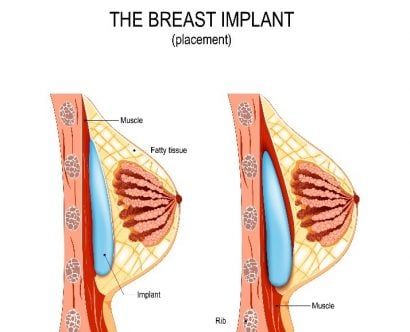 Breastfeeding After Cosmetic Breast Surgery